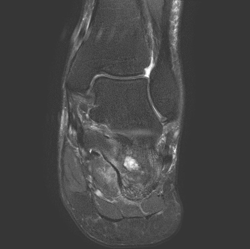 File:Aneurysmal bone cyst of the calcaneus (Radiopaedia 60669-68420 Coronal T2 fat sat 10).jpg