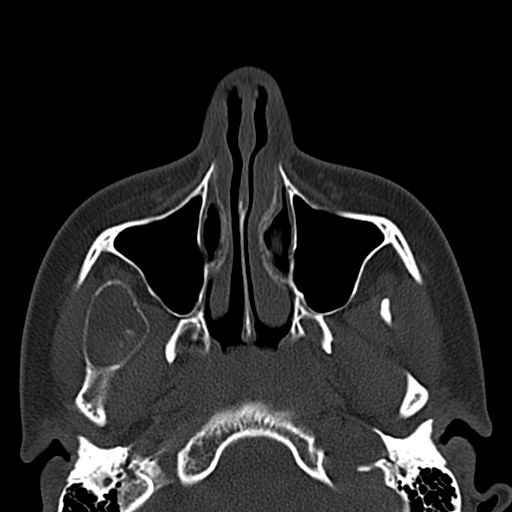 Aneurysmal bone cyst of the mandible (Radiopaedia 43280-46601 Axial bone window 68).jpg