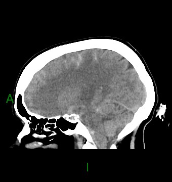 File:Aneurysmal subarachnoid hemorrhage with intra-axial extension (Radiopaedia 84371-99699 B 21).jpg