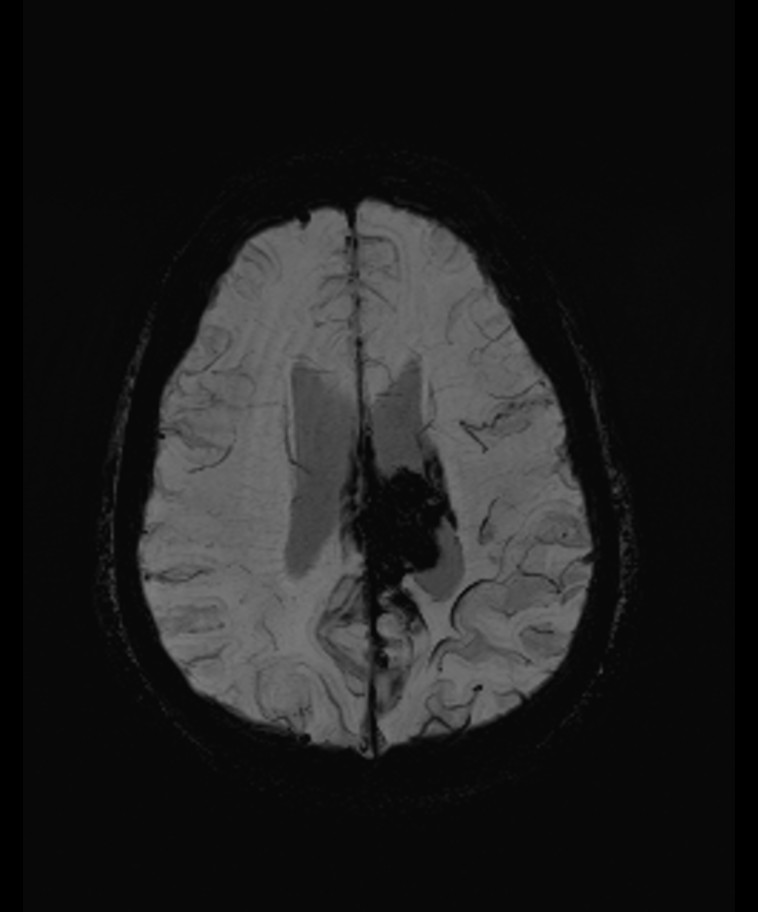 Angiomatous meningioma (Radiopaedia 79459-92579 E 46).jpg