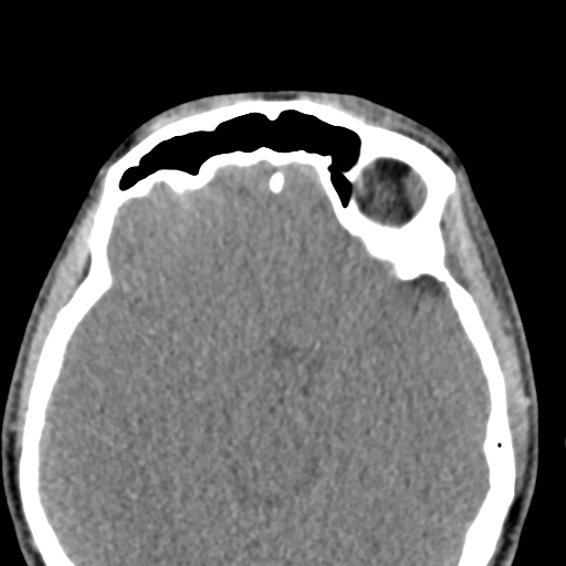 Angular dermoid cyst (Radiopaedia 88967-105790 Axial non-contrast 36).jpg