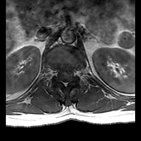 File:Ankylosing spondylitis with zygapophyseal arthritis (Radiopaedia 38433-40516 Axial T1 22).jpg
