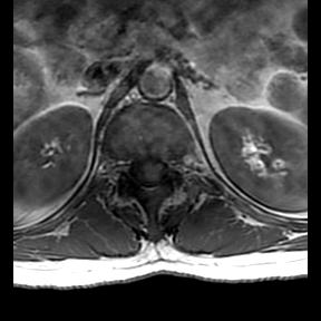 File:Ankylosing spondylitis with zygapophyseal arthritis (Radiopaedia 38433-40516 Axial T1 23).jpg