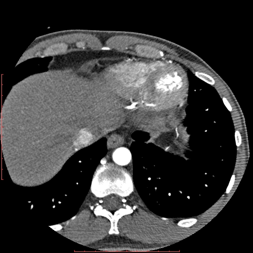 Anomalous left coronary artery from the pulmonary artery (ALCAPA) (Radiopaedia 70148-80181 A 352).jpg