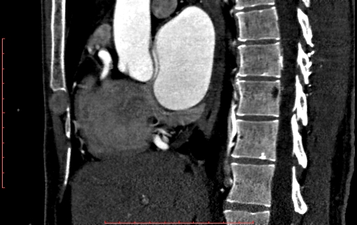 Anomalous left coronary artery from the pulmonary artery (ALCAPA) (Radiopaedia 70148-80181 C 96).jpg