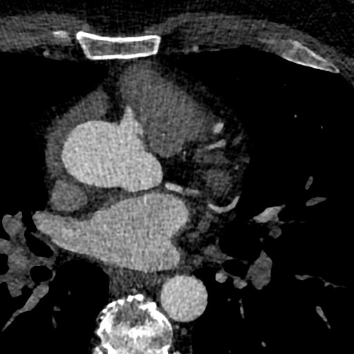 File:Anomalous origin of the left coronary artery with malignant course (Radiopaedia 77842-90126 C 44).jpeg