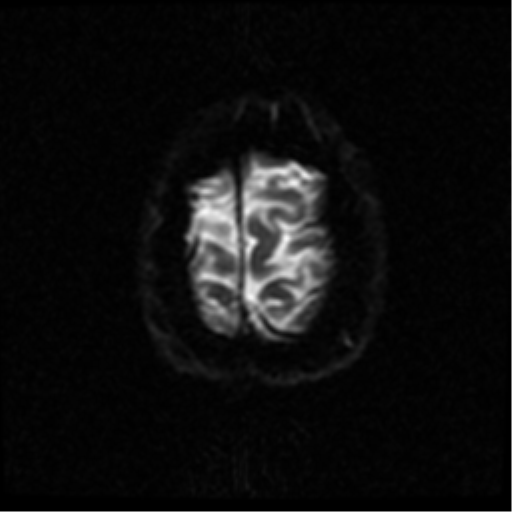 File:Anterior cerebral artery territory infarct (Radiopaedia 39327-41584 Axial DWI 50).png
