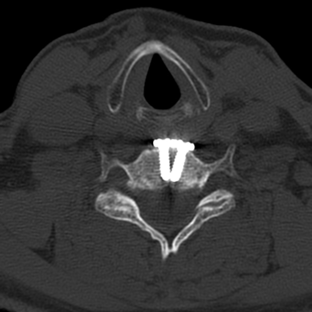 Anterior cervical postdiscectomy arthrodesis (Radiopaedia 32678-33646 Axial bone window 52).jpg