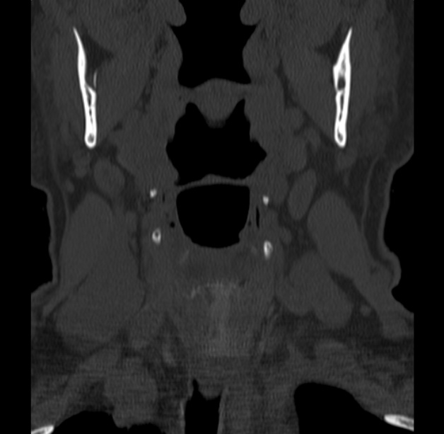 Anterior cervical postdiscectomy arthrodesis (Radiopaedia 32678-33646 Coronal bone window 1).jpg