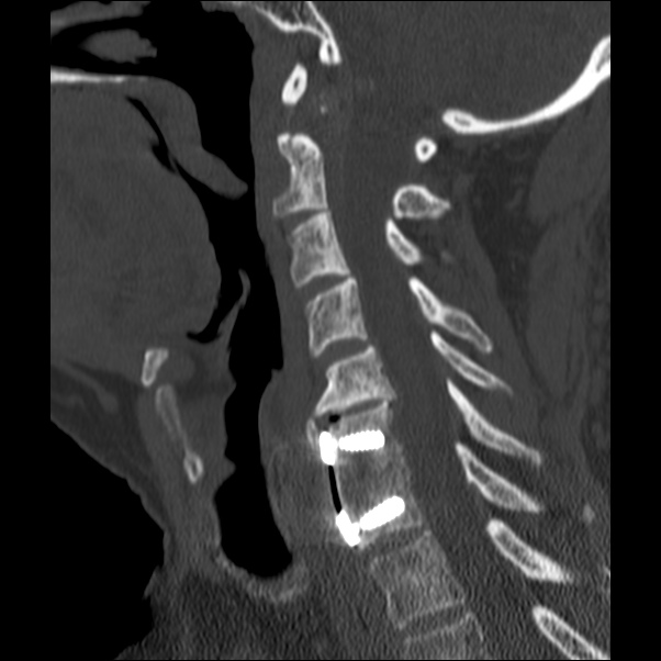 Anterior cervical postdiscectomy arthrodesis (Radiopaedia 32678-33646 Sagittal bone window 43).jpg