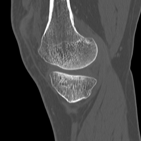 File:Anterior cruciate ligament avulsion fracture (Radiopaedia 58939-66194 Sagittal bone window 30).jpg