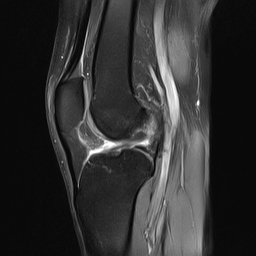 File:Anterior cruciate ligament full thickness tear (Radiopaedia 66268-75467 Sagittal PD fat sat 14).jpg