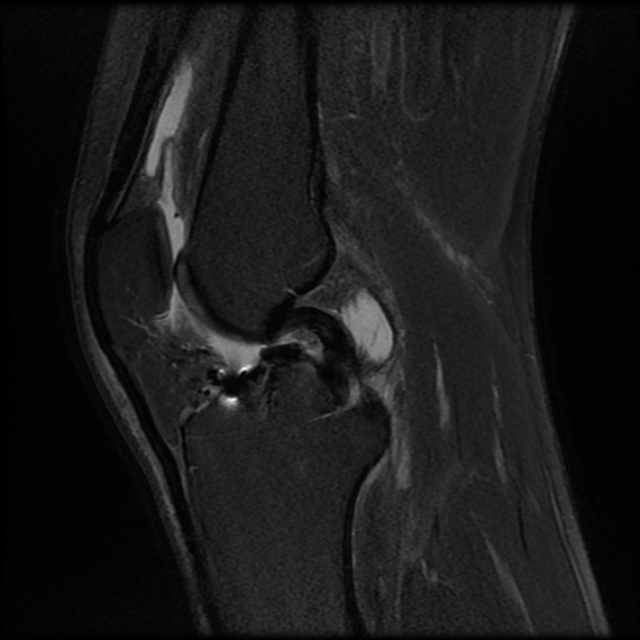 File:Anterior cruciate ligament graft tear and bucket-handle tear of medial meniscus (Radiopaedia 75867-87255 Sagittal PD fat sat 13).jpg