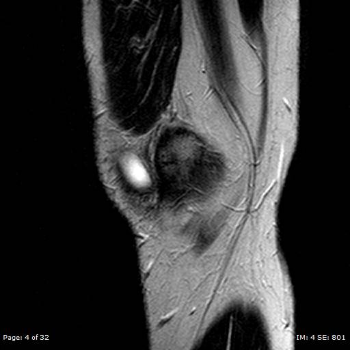 File:Anterior cruciate ligament tear (Radiopaedia 70783-80964 Sagittal T2 4).jpg