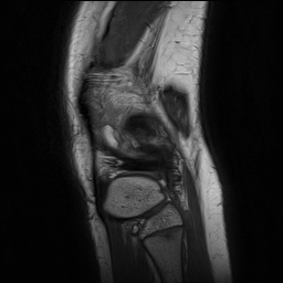 File:Anterior cruciate ligament tear - pediatric (Radiopaedia 62152-70260 Sagittal PD 150).jpg