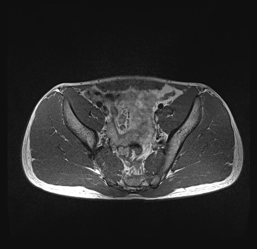 File:Anterior inferior iliac spine avulsion fracture (Radiopaedia 81312-95000 Axial T1 29).jpg