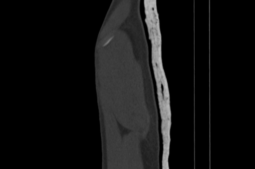 Anterior inferior iliac spine avulsion injury (Radiopaedia 88666-105376 Sagittal bone window 9).jpg