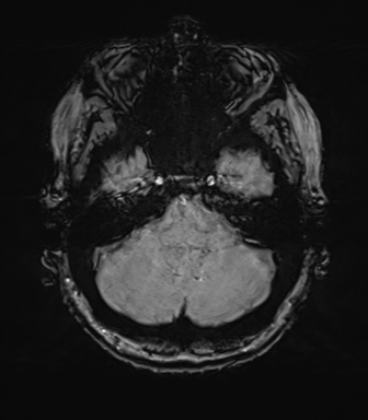Anterior temporal pole cysts (Radiopaedia 46629-51102 Axial SWI 20).png