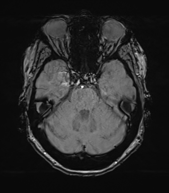 Anterior temporal pole cysts (Radiopaedia 46629-51102 Axial SWI 28).png