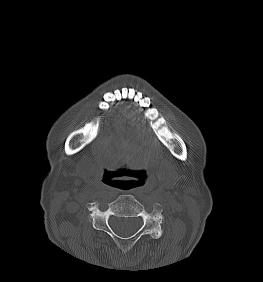 Anterior temporomandibular joint dislocation (Radiopaedia 59430-66784 Axial non-contrast 47).jpg