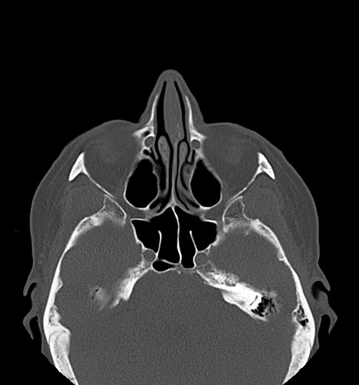 Anterior temporomandibular joint dislocation (Radiopaedia 59430-66784 Axial non-contrast 8).jpg