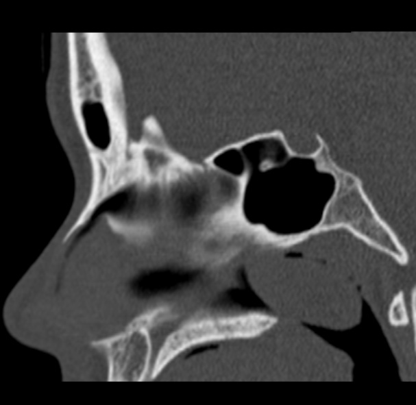 Antrochoanal polyp (Radiopaedia 33984-35202 Sagittal bone window 41).jpg