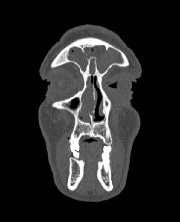 Antrochoanal polyp (Radiopaedia 79011-92169 Coronal bone window 74).jpg