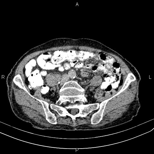 File:Aortic aneurysm and Lemmel syndrome (Radiopaedia 86499-102554 Axial C+ delayed 54).jpg