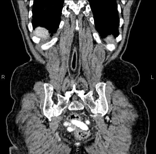 Aortic aneurysm and Lemmel syndrome (Radiopaedia 86499-102554 C 58).jpg