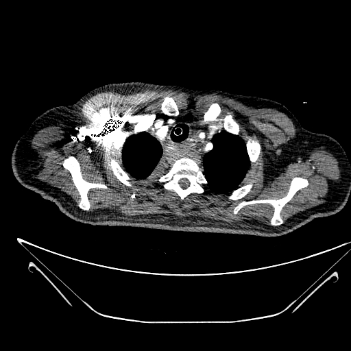 Aortic arch aneurysm (Radiopaedia 84109-99365 B 99).jpg