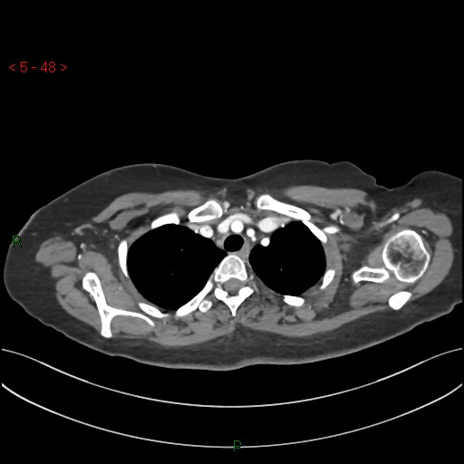 Aortic arch origin of left vertebral artery (Radiopaedia 51520-57286 A 47).jpg