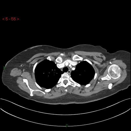 Aortic arch origin of left vertebral artery (Radiopaedia 51520-57286 A 55).jpg