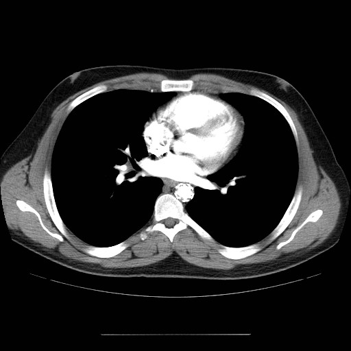 File:Aortic arch stent (Radiopaedia 30030-30595 D 21).jpg