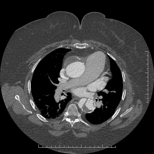 File:Aortic dissection- Stanford A (Radiopaedia 35729-37268 A 44).jpg