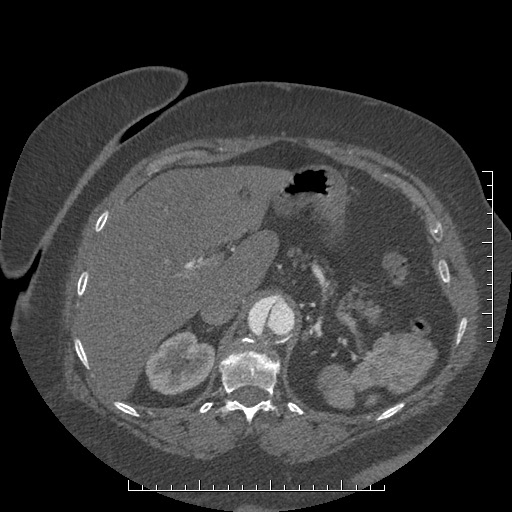 File:Aortic dissection- Stanford A (Radiopaedia 35729-37268 B 39).jpg