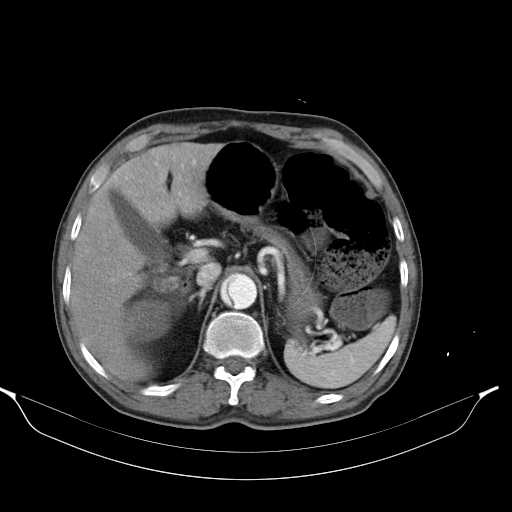 Aortic dissection- Stanford type A (Radiopaedia 22085-22085 A 40).jpg
