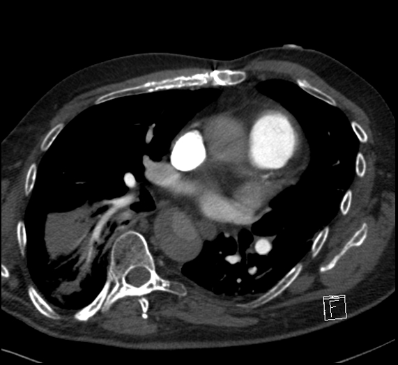 File:Aortic dissection (CTPA) (Radiopaedia 75506-86751 Axial C+ CTPA 74).jpg