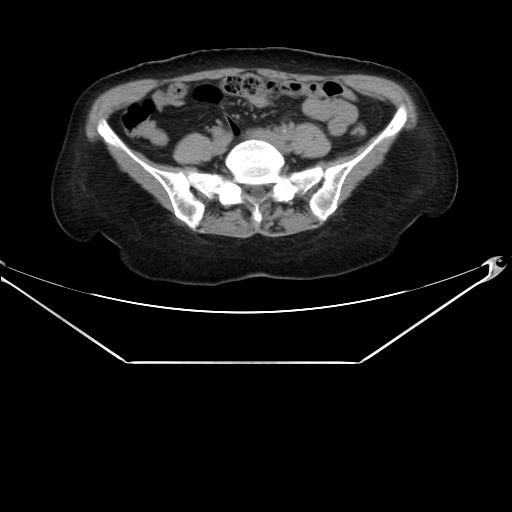 Aortic dissection (Radiopaedia 25350-25604 B 59).jpg