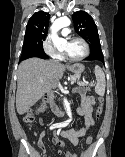 Aortic dissection (Radiopaedia 44411-48061 A 17).jpg