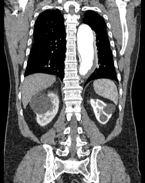 Aortic dissection (Radiopaedia 44411-48061 A 49).jpg