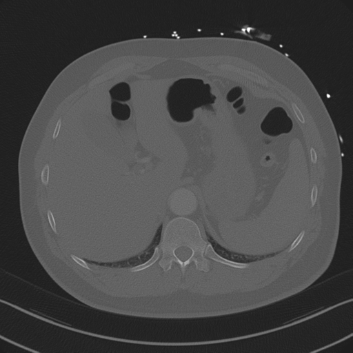 Aortic dissection (Radiopaedia 50763-56234 Axial bone window 94).png