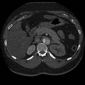 Aortic dissection (Radiopaedia 57969-64959 A 346).jpg