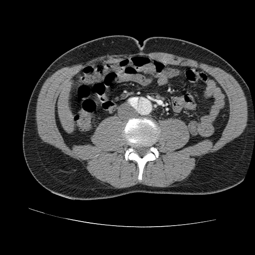 Aortic dissection - Stanford A -DeBakey I (Radiopaedia 28339-28587 B 153).jpg