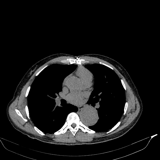 Aortic dissection - Stanford type A (Radiopaedia 83418-98500 Axial non-contrast 22).jpg