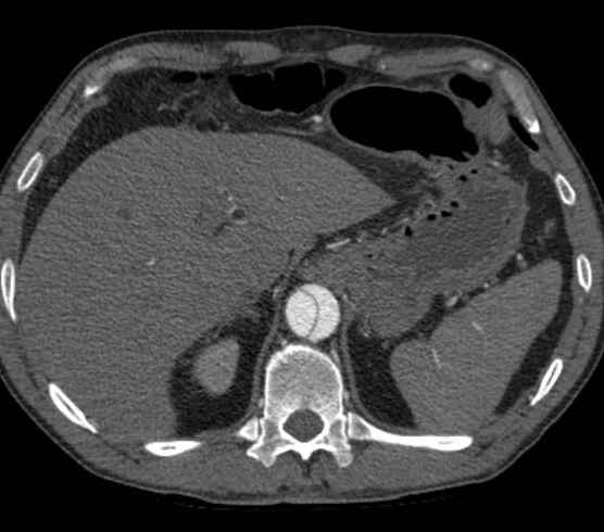 File:Aortic dissection - Stanford type B (Radiopaedia 73648-84437 A 111).jpg