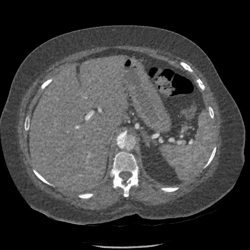 Aortic dissection - Stanford type B (Radiopaedia 88281-104910 A 97).jpg