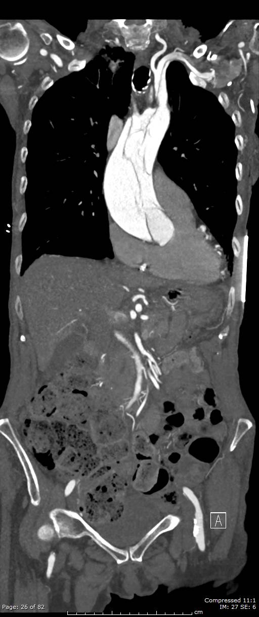 Aortic dissection with extension into aortic arch branches (Radiopaedia 64402-73204 A 26).jpg