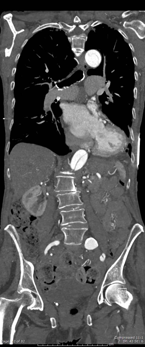 Aortic dissection with extension into aortic arch branches (Radiopaedia 64402-73204 A 42).jpg