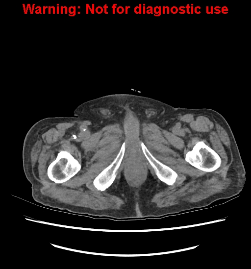 File:Aortic graft infection (Radiopaedia 44979-48907 Axial non-contrast 99).jpg