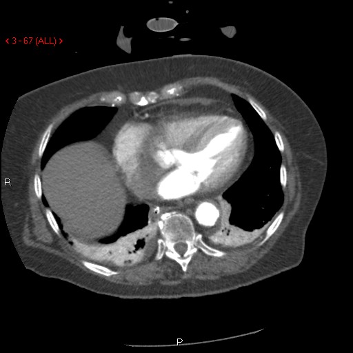 Aortic intramural hematoma (Radiopaedia 27746-28001 A 67).jpg